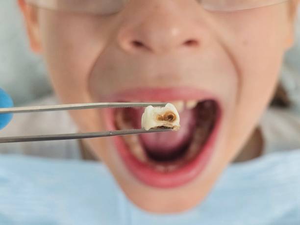 Best Emergency Root Canal Treatment in Malakoff, TX